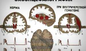 Что такое эхоэнцефалография головного мозга (ЭхоЭГ), что она показывает и какие имеет преимущества