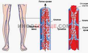 Что лучше — Тромбоасс или Кардиомагнил?