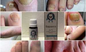 Противогрибковое средство Варанга