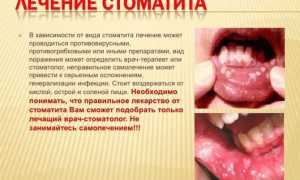 Стоматит: симптомы, причины, лечение и профилактика