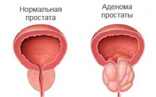 О чем могут свидетельствовать постоянные позывы к мочеиспусканию у мужчин