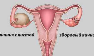 Как делают УЗИ на определение кисты яичника и как разные виды выглядят на мониторе