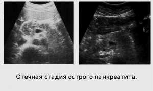 Видно ли панкреатит на УЗИ и что конкретно покажет исследование на мониторе