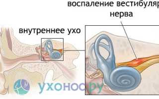 Неврит слухового нерва: причины, признаки, как лечить