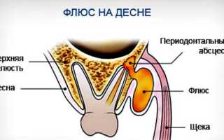 Гной в десне: что делать в домашних условиях, хирургическое и медикаментозное лечение