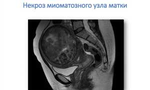 Некроз миоматозного узла, опасно ли это