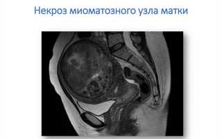 Некроз миоматозного узла, опасно ли это