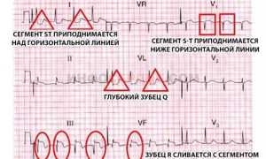 В чем особенность трансмурального инфаркта миокарда?