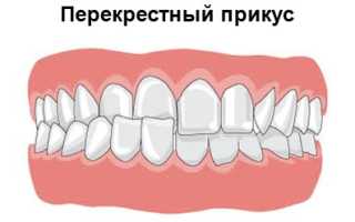 Неправильный прикус: причины, исправление, профилактика