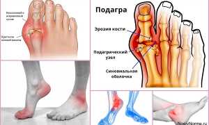 Что такое подагрический артрит, чем и как лечить патологию?