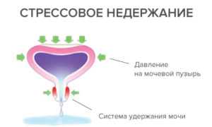 Лечение стрессового недержания мочи у женщин
