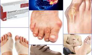 Hallux Valgus: причины, симптомы, лечение