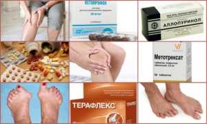 Лечение артрита современными медикаментами