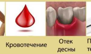 Нужно ли принимать антибиотики после удаления зуба, какой антибиотик лучше