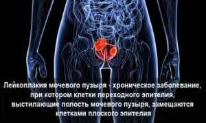 Что такое лейкоплакия мочевого пузыря — признаки, лечение