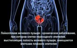 Что такое лейкоплакия мочевого пузыря — признаки, лечение