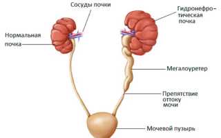 Причины и степени гидронефроза левой почки: лечение и прогноз