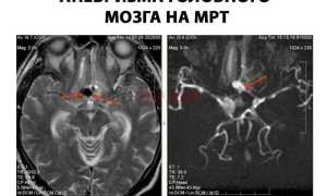 Опасность аневризмы сосудов головного мозга и возможные последствия