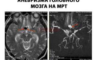 Опасность аневризмы сосудов головного мозга и возможные последствия