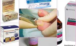 Чем и как размягчить грибковые ногти на ногах в домашних условиях?