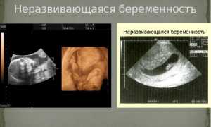 Причины неразвивающейся беременности: что они за собой влекут
