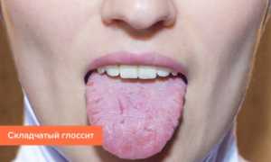 Воспаление сосочков на корне и кончике языка, причины увеличения (гипертрофии)