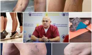 Гимнастика Бубновского при варикозе вен на ногах