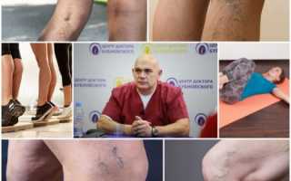 Гимнастика Бубновского при варикозе вен на ногах