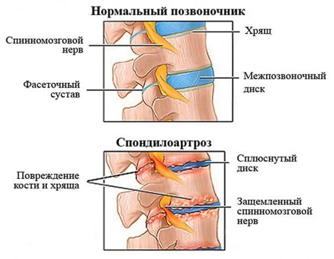Эльбона-Ультра улучшает состояние суставов при их поражении заболеваниями