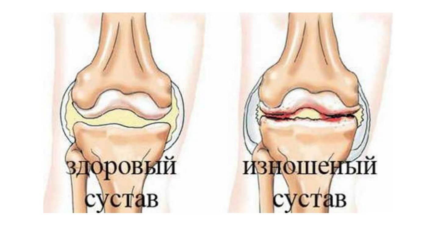 Артифлекс - один из аналогов Артрокера