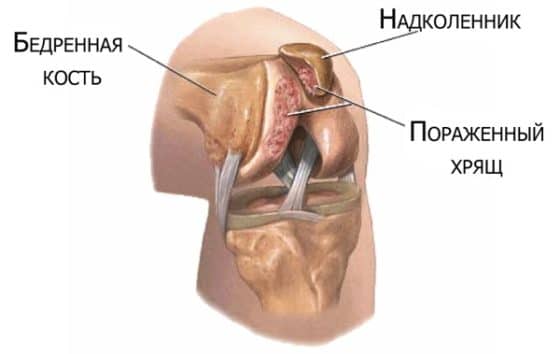 Хондромаляция хряща надколенника - показание для приема Сустагард Артро в виде порошка
