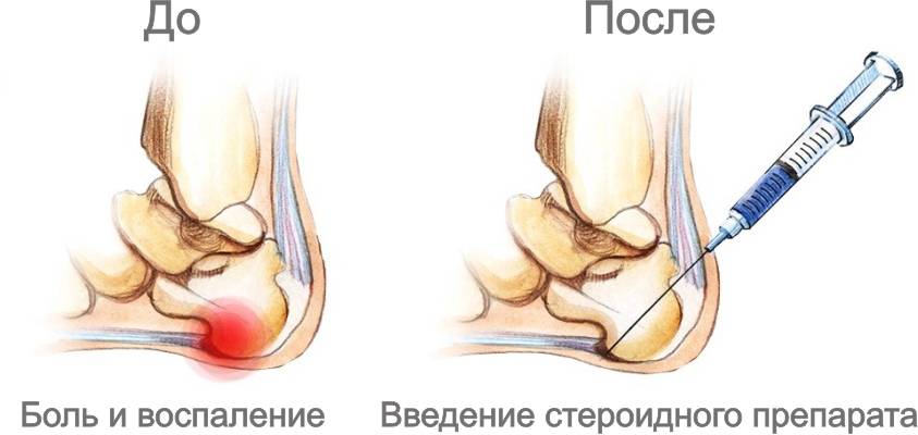 Проведение блокады снимает боль и воспаление 