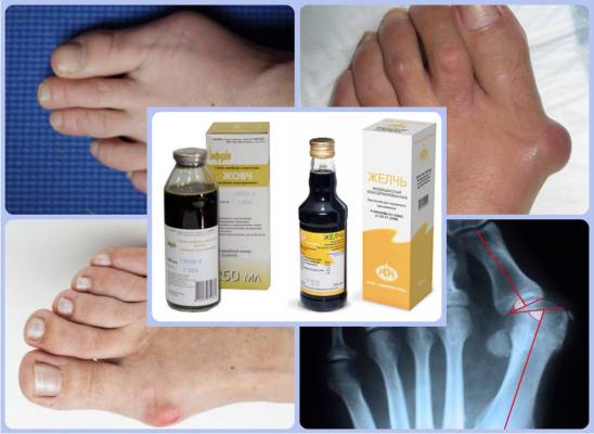 Медицинская желчь при hallux valgus