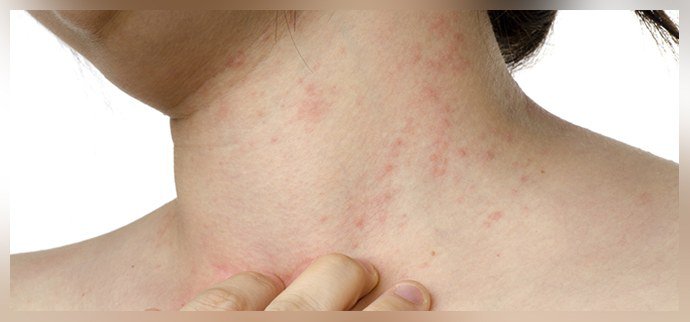 Аллергия и псориаз Аллергия и псориаз