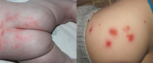 проявление аллергии на попе у малыша