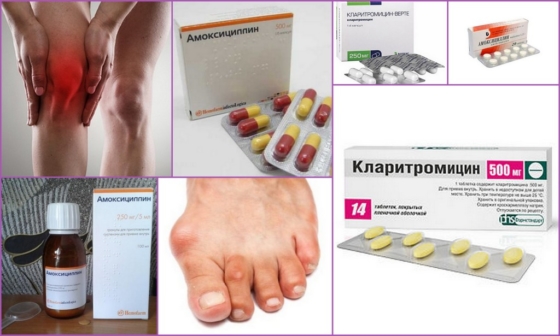 Антибиотики для лечения ревматизма