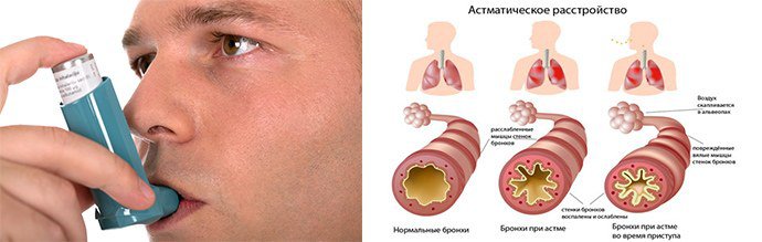 бронхиальная астма