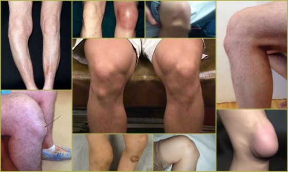 Болезнь Шляттера - внешние проявления патологии