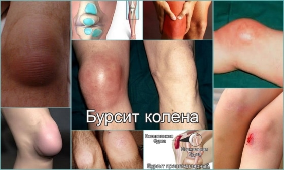 Бурсит – виды и особенности течения патологии