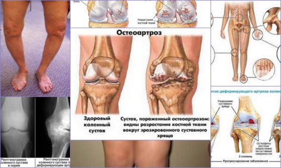 Деформирующий остеоартроз – внешние характеристики патологии