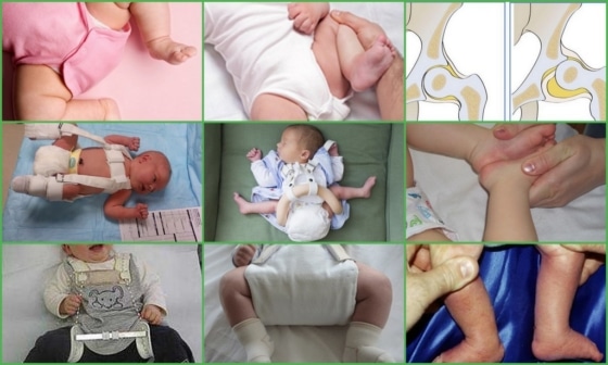 Дисплазия тазобедренного сустава у грудничка - Комаровский