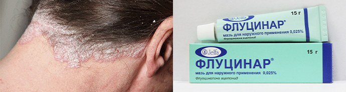 использование гелей при псориазе