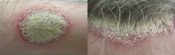 генерализованная форма псориатической эритродермии генерализованная форма псориатической эритродермии