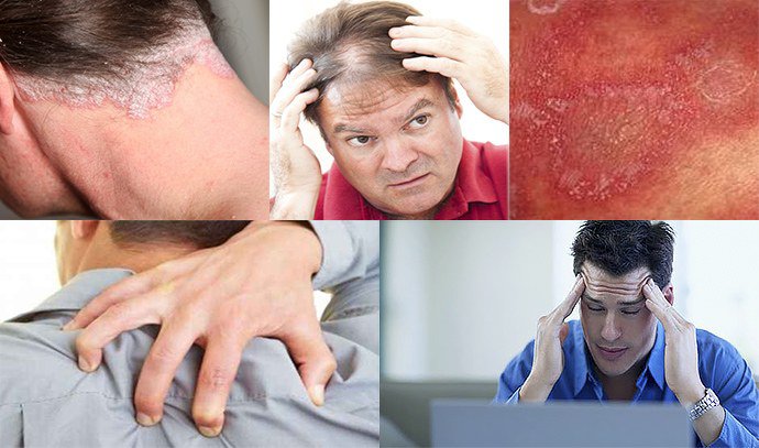 гиперергическая форма псориатической эритродермии гиперергическая форма псориатической эритродермии