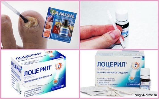Использование Лоцерила и Ламизила