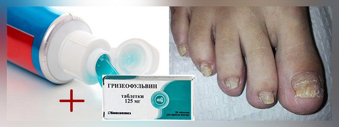 Комплексное лечение грибка ногтей
