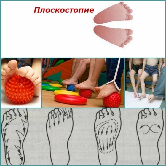 Лечебная физкультура при плоскостопии