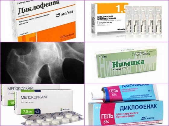 Лечение медикаментами диспластического коксартроза