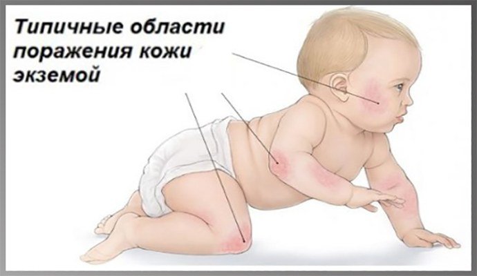 Локализация экземы