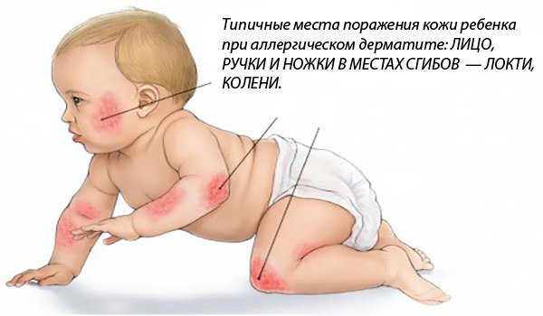 места локализации дерматита